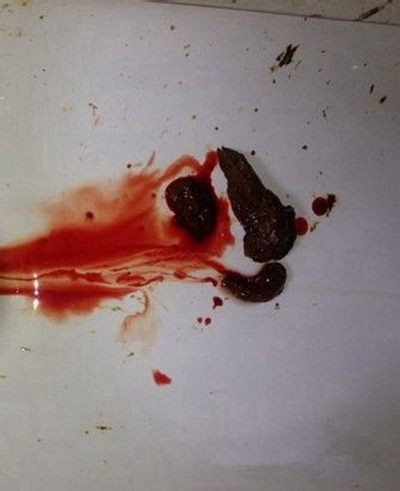 結腸癌症狀 (51) 