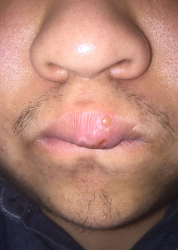 嘴唇潰瘍