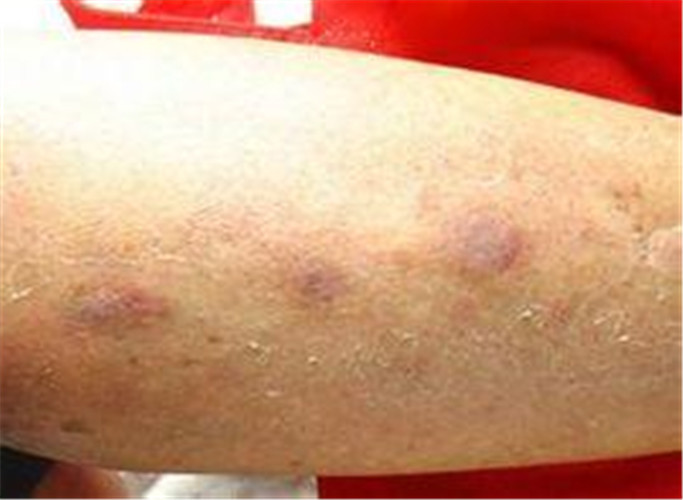 白塞病手臂症狀