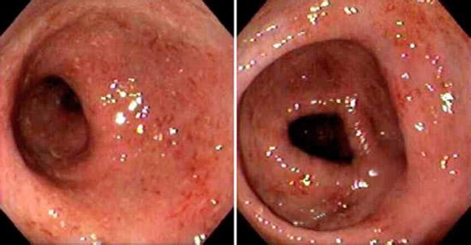 缺血慢性結腸炎患者