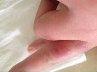 系統性紅斑狼瘡診斷標準 (8) 