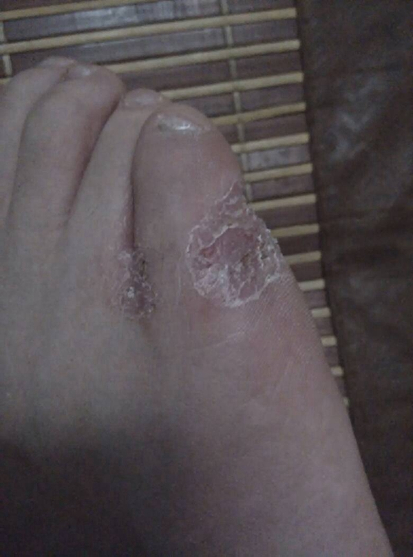 小腳趾腳蘚