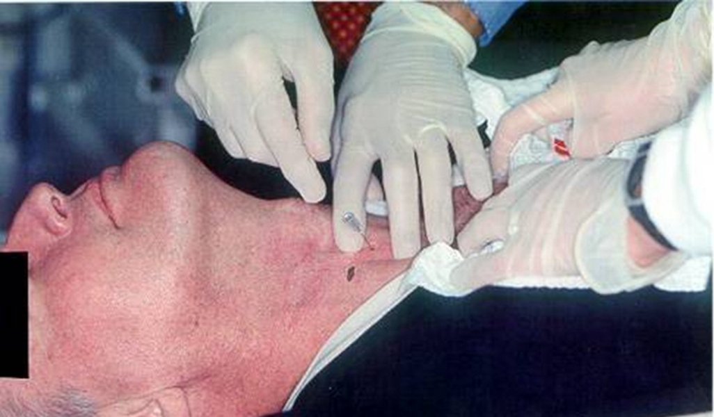 橋本甲狀腺炎治療