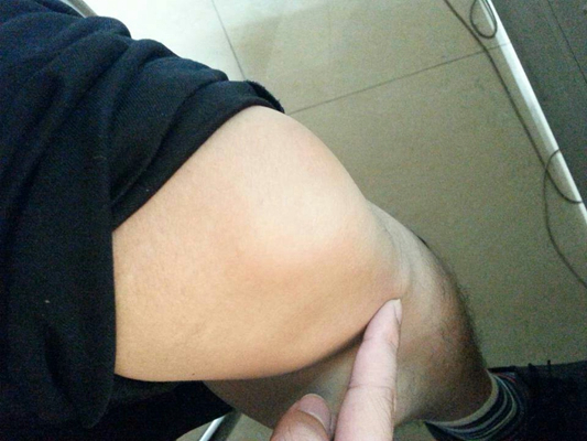 膝蓋半月板損傷症狀 (42) 