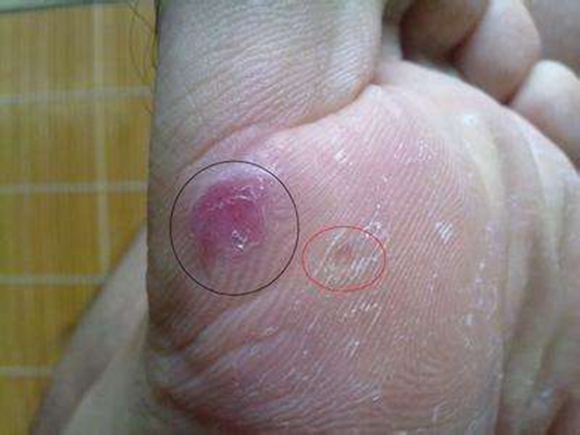 腳底蹠疣早期