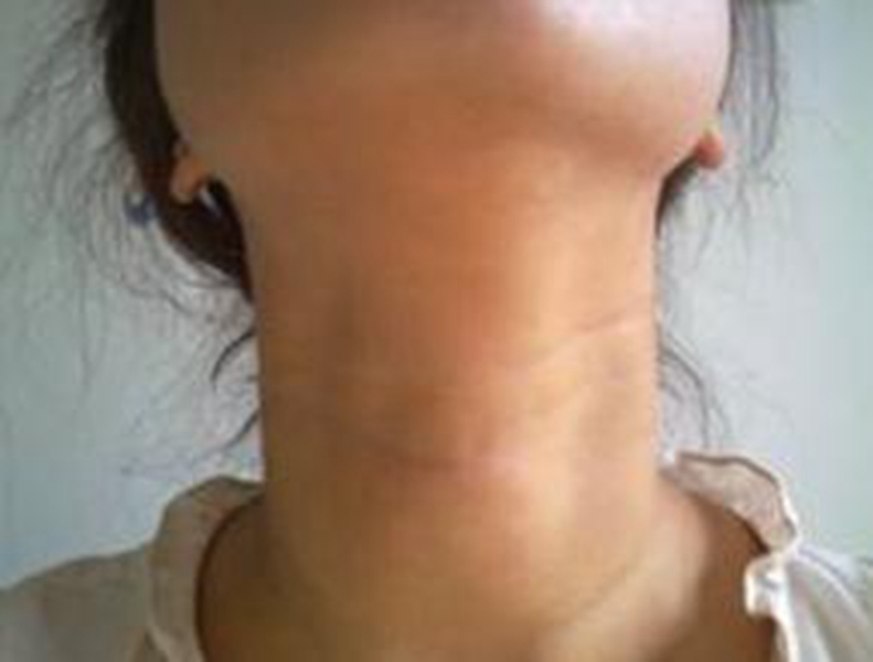 橋本甲狀腺炎腫大初期