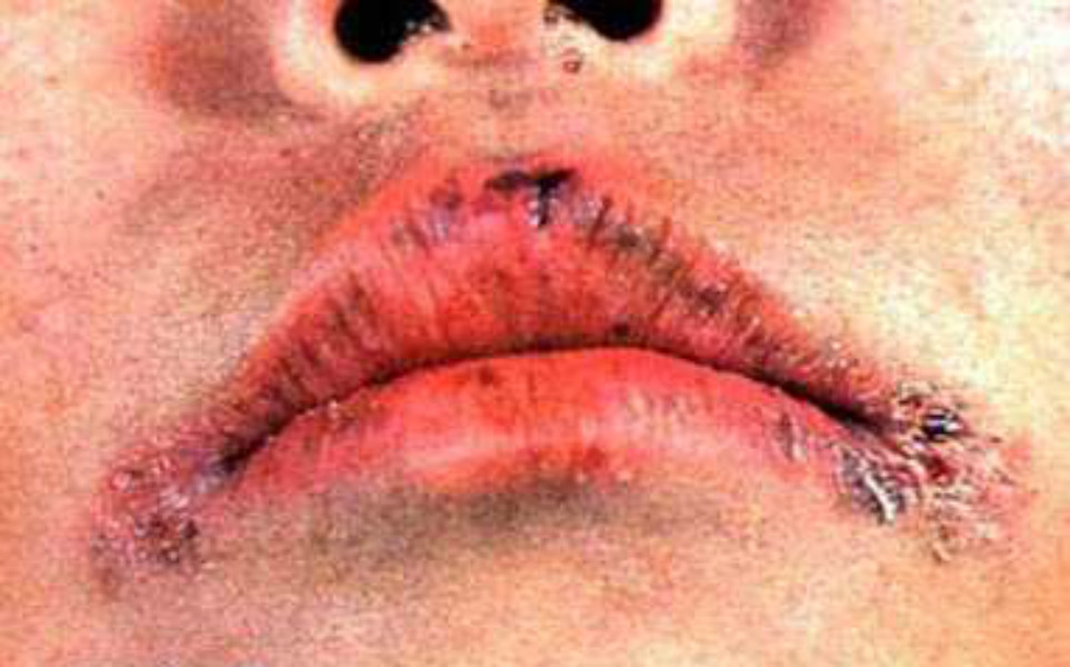 嘴唇皮膚念珠菌病