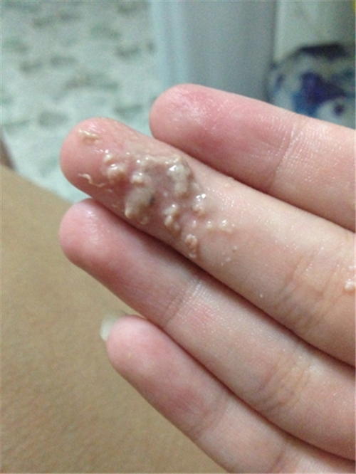 外陰癌外陰分泌物