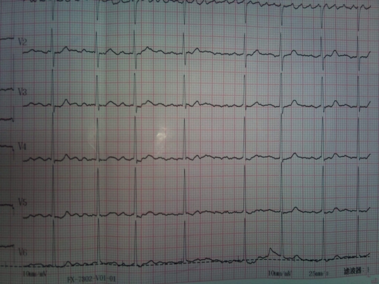 預激綜合徵心電圖 (8) 