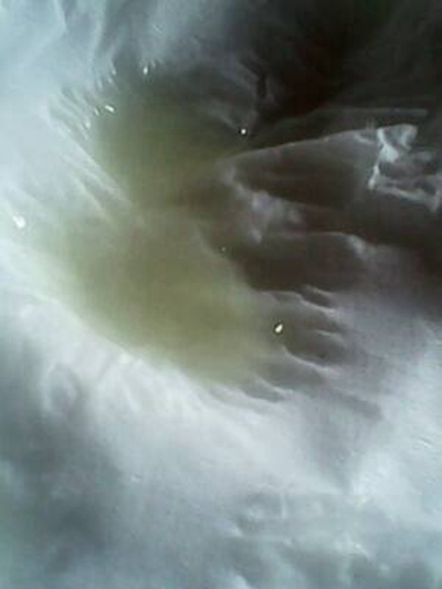 不正常精液液化