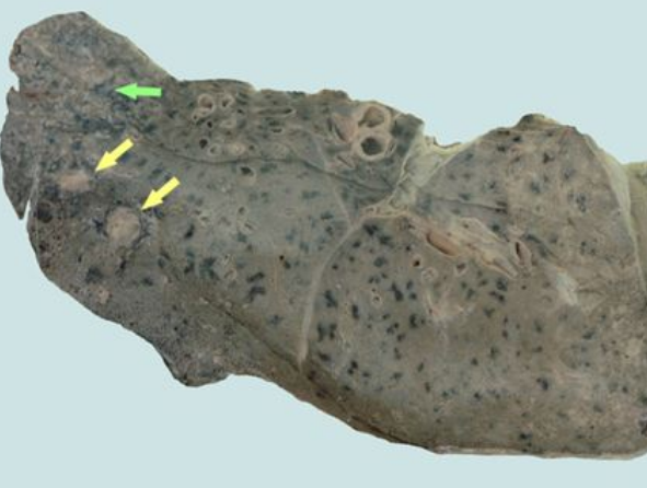 空洞型肺結核能活多久 (50) 