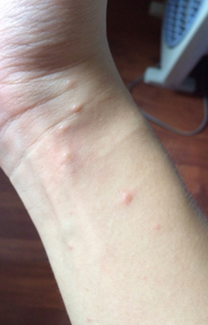 身體蟎蟲過敏症狀