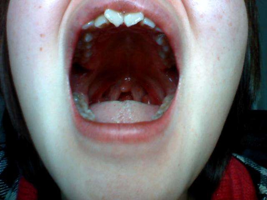 食道炎的症狀圖 (56) 