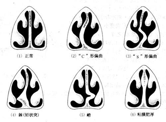 鼻中隔彎曲手術圖解 (43) 