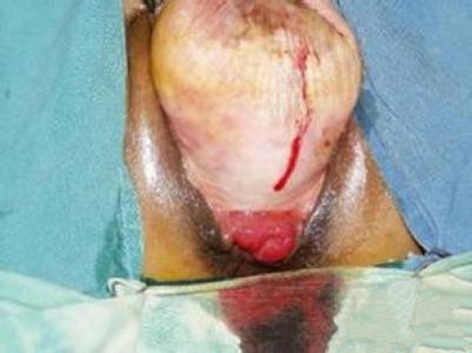 子宮脫垂要注意