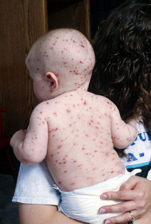 長水痘的症狀 (53) 