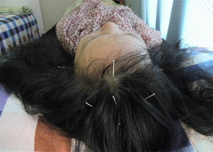 針灸治療腦供血不足