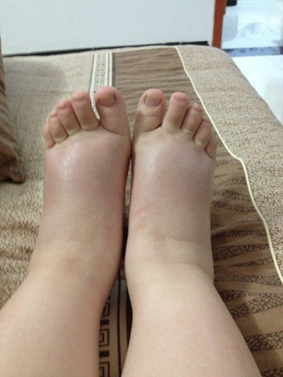 肢端肥大症  (5) 