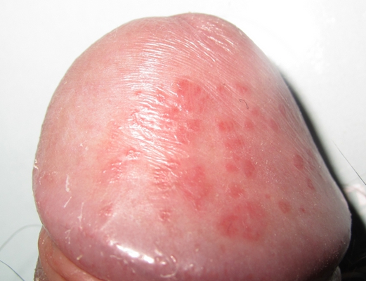 黴菌性龜頭炎 (26) 