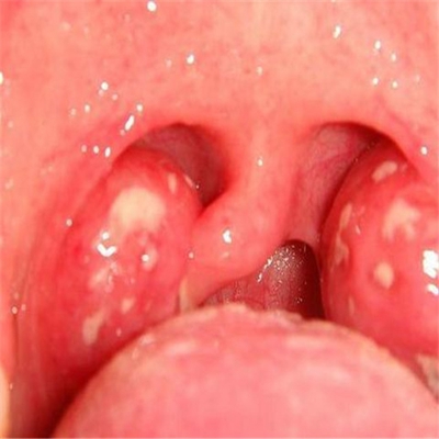 扁桃體癌圖  (57) 