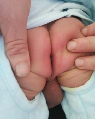 寶寶紅屁屁照片 (7) 