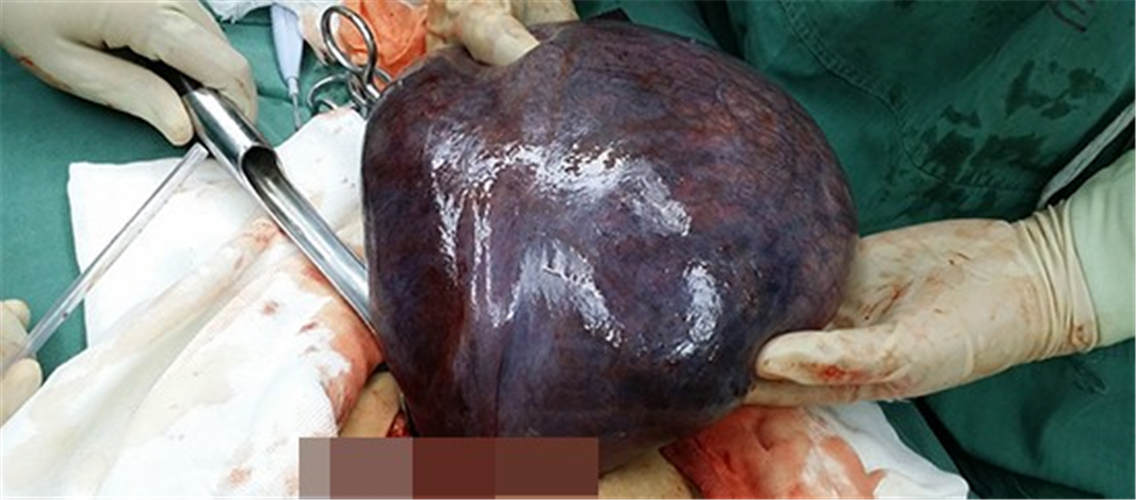 少女巨大卵巢囊腫