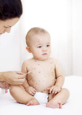 長水痘的症狀 (59) 