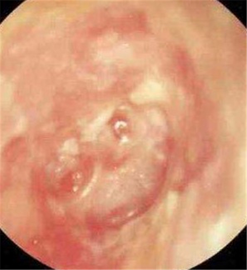 秋季急性中耳炎鼓膜