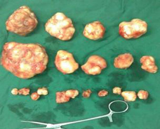 子宮肌瘤真實切除後