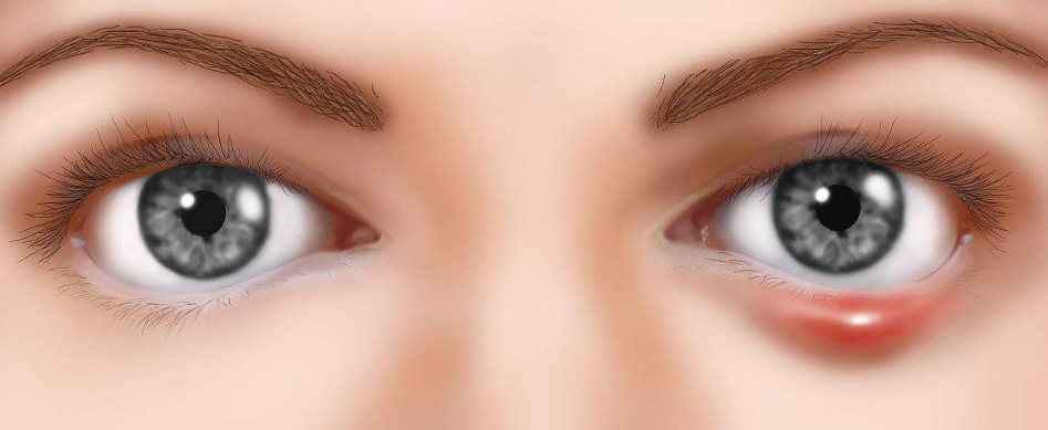 眼睛麥粒腫初期