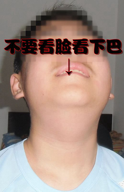 頜下淋巴結腫大