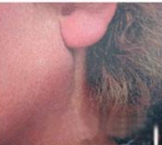 腋處淋巴癌早期症狀