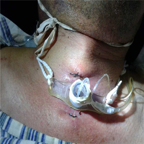 重症呼吸道感染培養