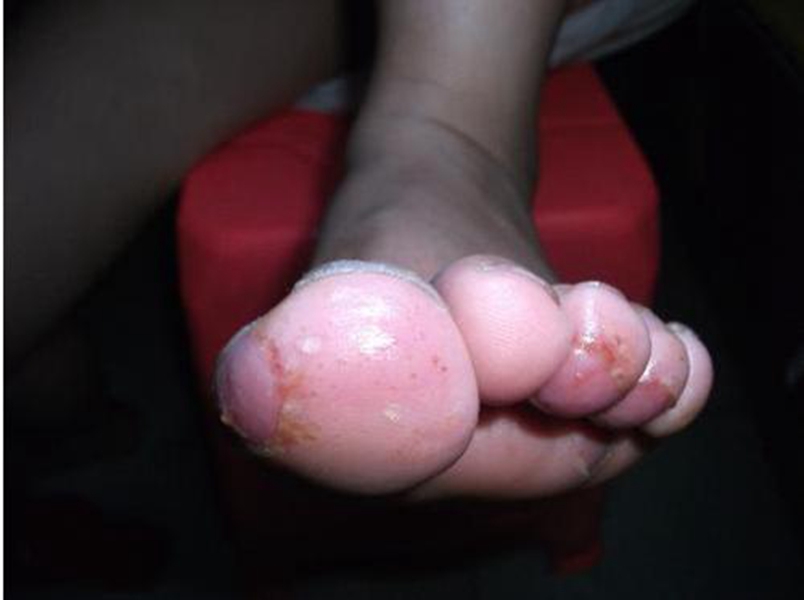 因腳蘚引起潰爛