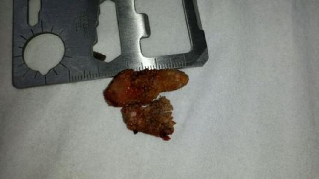 體內取出的腎結石