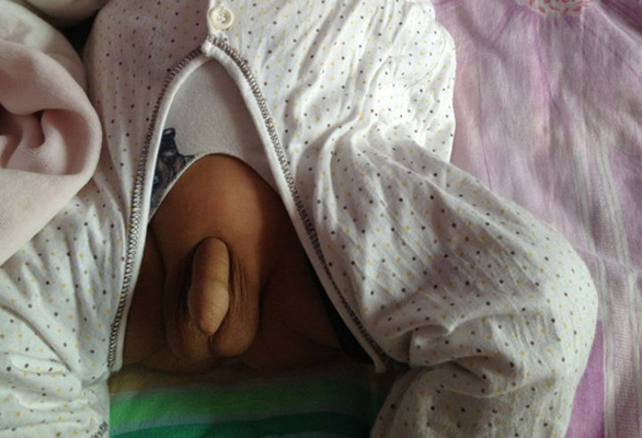 男寶寶疝氣的症狀