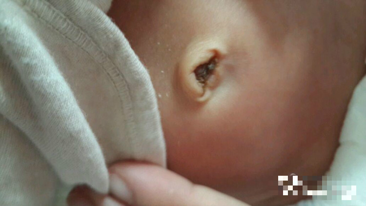 新生兒肚臍脫落圖 (7) 