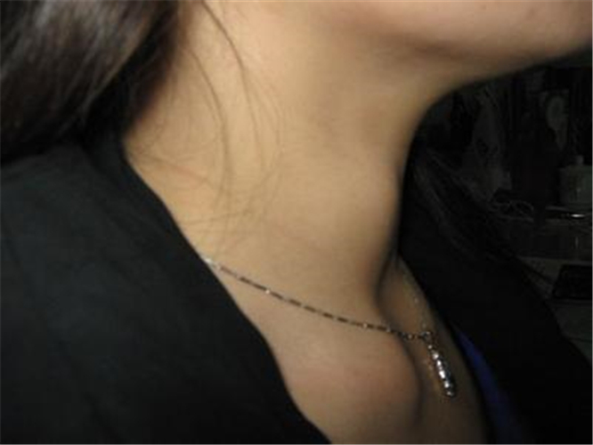 女性甲狀腺結節症狀