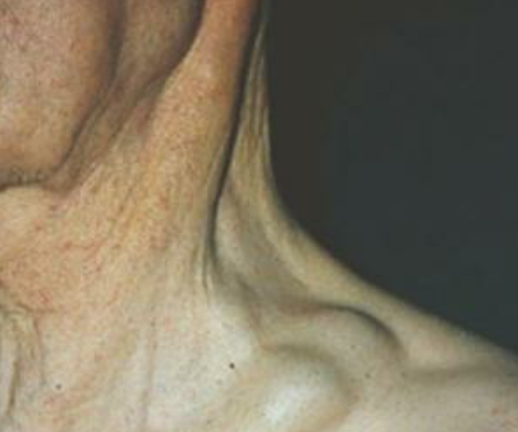 腹股溝淋巴瘤症狀有哪些 