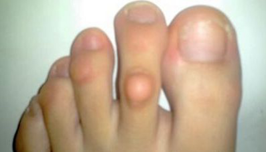 胼胝體的發育不良