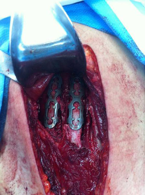 手術固定後的肋骨骨折