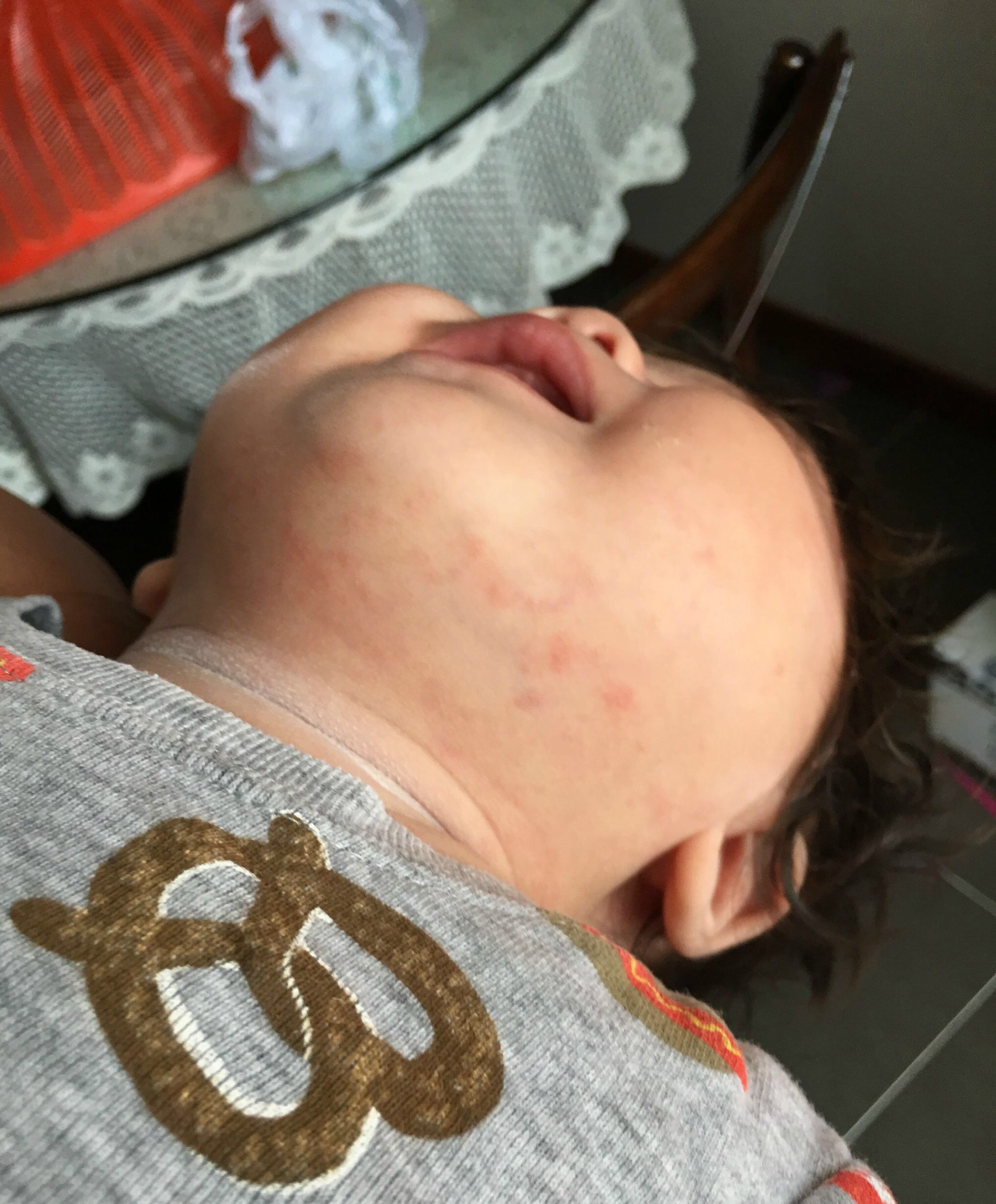 小兒急疹的症狀 (40) 