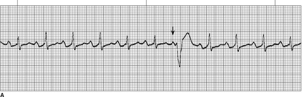 頻發房性早搏 (5) 