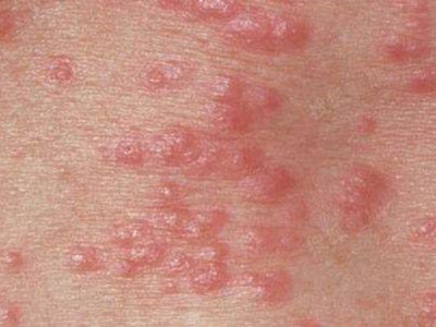 性病性淋巴肉芽腫套圖 (47) 