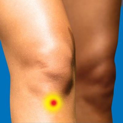 脛骨結節骨骺炎 (47) 