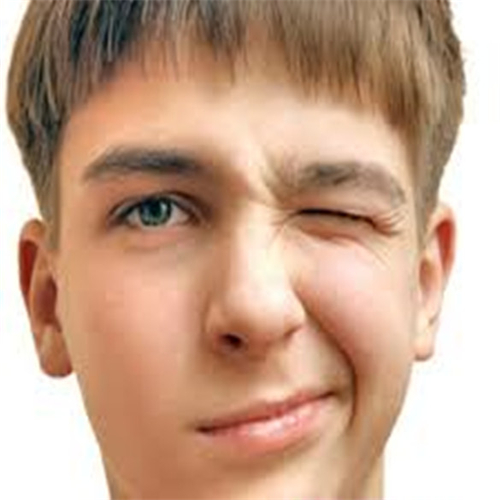 原發性面肌痙攣的症狀