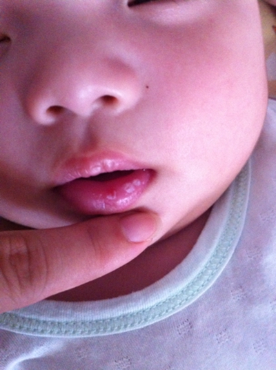 口腔念珠菌感染 (8) 