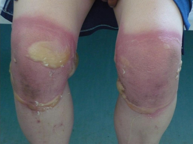 膝蓋接觸性皮炎