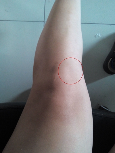 脛骨結節骨骺炎 (5) 