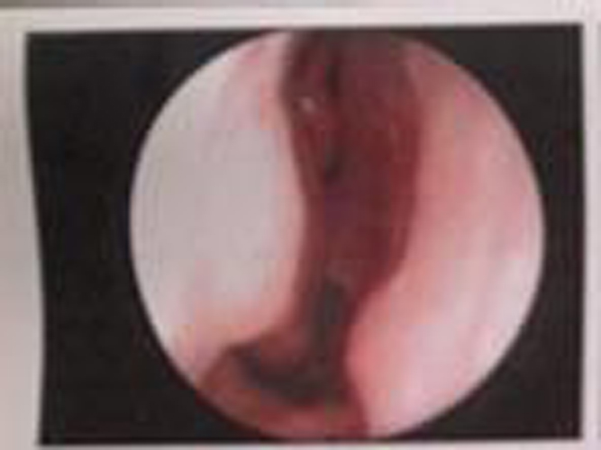 輕微的息肉慢性鼻炎